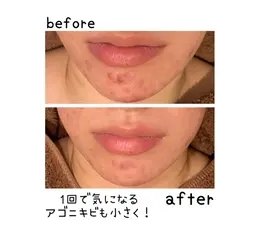 90分11000円❣️ご褒美エステ❤️乾燥撃退❣️温泉由来の蜜蝋パック♨️ 首＊肩＊デコルテマッサージでコリほぐし✨