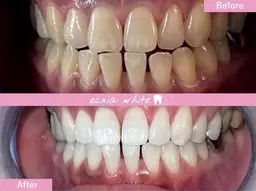 【12/5.6限定★】口内管理★セルフホワイトニング(9分×2回)1回(追加料金無し)3,980円→