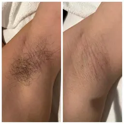 【メンズ脱毛】選べる！脇or手の甲指脱毛　¥1,980