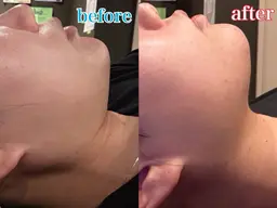 12月限定✨小顔超音波エステ｢プレゼント付き｣🩷