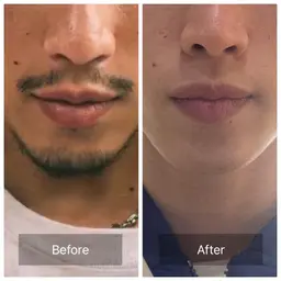 【プラチナビーム脱毛】髭脱毛1回（メンズ）