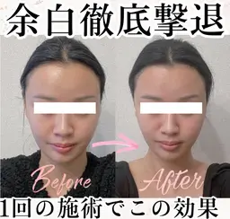20代限定🌟SNS映え美小顔🖤写真写りが劇的に改善！痛くないオールハンド施術💆🏻‍♀️浮腫みたるみほうれい線に✨