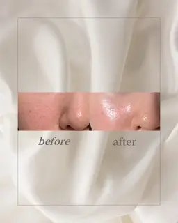 肌質ケアハーブピーリング【フェイシャル】