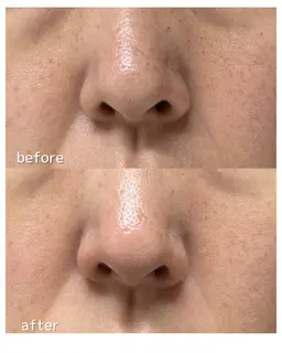 【ハリ・トーンUP】セルフ超音波エステ　15分