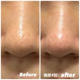 角栓除去＆毛穴エクストラクション