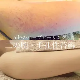 二の腕ハーブピーリング🌿毛孔性苔癬でお悩みの方👗❤️ハーブピーリングハード（自然剥離あり）