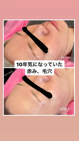 寝落ち率90%😳極上マッサージ付き✨しつこいニキビに終止符を👊🏼【業界最多天然針】剥離なしハーブピーリング 75分