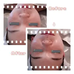 ニキビ跡でお悩みの方お任せください☆剥離しないハーブピーリング＋オーガニックフェイシャル♡スペシャルメニュー70分