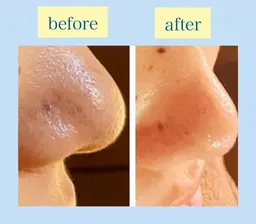 【初回限定】ハイドロフェイシャル毛穴洗浄コース