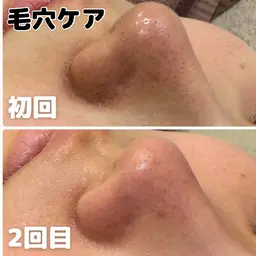 【毛穴の黒ずみ詰まりに】毛穴洗浄＋フェイシャルマッサージ＋保湿パック