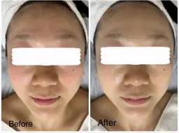 【美肌エステ】デコルテケア付でリラックス！ワンランク上の極上フェイシャルエステ💆‍♀️肌質＆トラブル別パック付き🩷