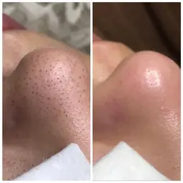 茨城初の毛穴エクストラクションtete式♡今だけ限定♡お試し価格❤︎とにかくエグっ！！！