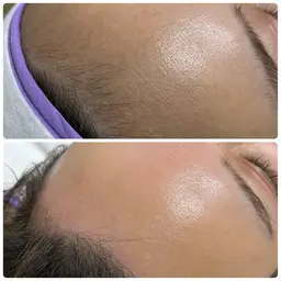 人気の脱毛メニュー🤎【フェイシャルwax✖️光脱毛💆♀️】脱ニキビ❣️