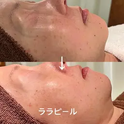 ララピール｜優しいピーリングでつるん肌へ