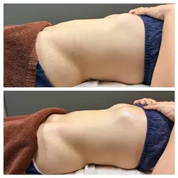 【1番人気】キャビリポプロ×ノンエフ痩身ケア《1部位》40分