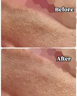 つるん肌ෆ ̖́-フェイスワックス脱毛