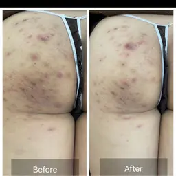 つるんとした美尻へ🍑ハーブピーリング剥離有り・無し選べます😆通常¥22,000円→初回お試し価格9,800円