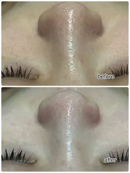 日にち、時間限定！ハイドラフェイシャル★【頑固な黒ずみごっそり！】毛穴洗浄×ヒト幹細胞＆ラジオ波