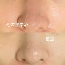 【ハーブピーリングよりも優しく角質除去🫶🏼💗】イオンピーリングと温熱パックで変化を実感したい方専用❕❕✨