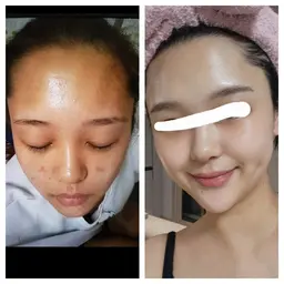 ニキビでお悩みの方限定✨️ニキビの原因を改善！