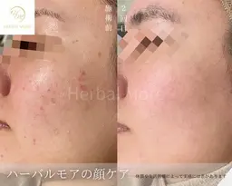 【3月限定/お試し】ハーブピーリング＋毛穴洗浄　✨¥33,000→¥5,980👧🏻💕