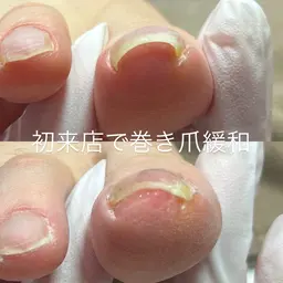 オーナー津蔵が担当する『フットの巻き爪・陥入爪解消メニュー』 無料　※必ず補足説明をご確認ください。