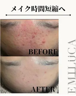 【剥離あり】顔🌿ハーブピーリング