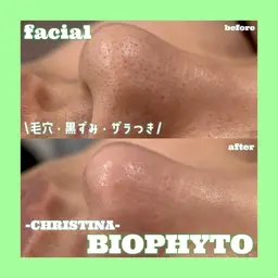 【毛穴のつまり・黒ずみ🫧】ダウンタイム無しハーブピーリング🌿変化即実感🔥つるんとタマゴ肌✨️