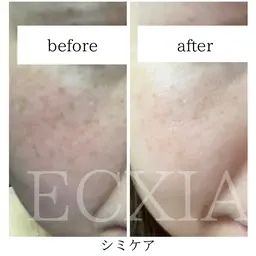 【シミケア】シミケア単品　《10分打ち放題》