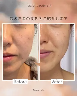 フェイシャルエステ