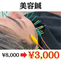 【✨ミニモSALE✨】美容鍼(たるみ ほうれい線 リフトアップ)(60分)