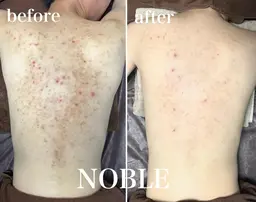 剥離ありハーブピーリング1部位（背中上/背中下/二の腕/前腕/デコルテ）＋2,000で背中全体に変更可◎