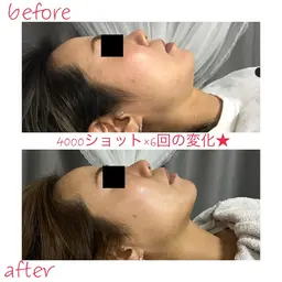 大人気❤️小顔リフトアップ4000ショット