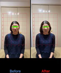 【リフトアップする】フェイスラインのむくみやたるみを軽くする美容鍼+小顔整体　　　　　　　　　枚方市駅/徒歩5分