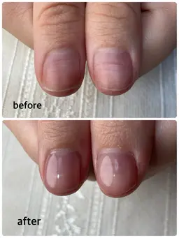 【⚠️終了】〈軽度の深爪〉※先着2名様“深爪を改善する施術”のモニター募集（応募条件あり）