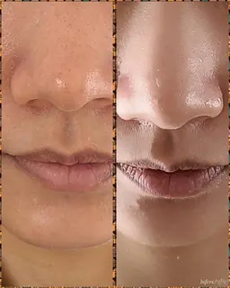 顔脱毛＋角栓除去（ダニ取り）＋毛穴掃除！徹底的にお掃除しましょう！今年の汚れは今年のうちに！