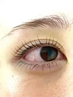 【上下マツパ＋マイクロニードルピーリング✨】マツパと纏めて気になるニキビ跡や毛穴ケア😊