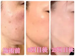 肌質改善VOSイノスピキュール15万本