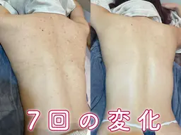 【極艶ボディ/痩身】お尻or背中[上部/下部]orデコルテハーブピーリング¥22000