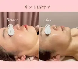✨🫧【3月限定】【韓国小顔/すっきりフェイス】リフトUP小顔フェイシャル💆🫧✨