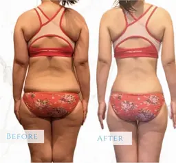 【くびれ爆誕❣️】タイトニングマシン×キャビRF贅沢マシン2種の徹底痩身メニュー