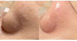 人気NO.１★【小顔】コルギ小顔矯正+超音波毛穴洗浄＋黒ずみ吸引　¥6600➡️5980