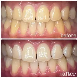 ✨ホワイトニング✨ナチュラルホワイトニング8分×3照射🦷🪥