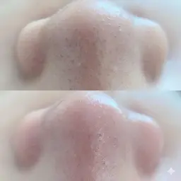 【初回限定】毛穴洗浄Tゾーン メンズもおすすめ🌟