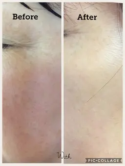 リベルハーブピーリング（お肌の生まれ変わり）剥離するピーリングです💕他社のピーリング剤より5​〜​6倍多い棘配合😎即効果