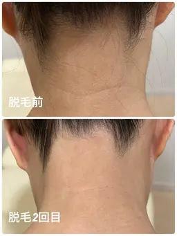 【横顔＆後ろ姿レベルUP】つるすべうなじ脱毛　4,500円→3,000円