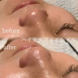 ハイドラフェイシャル（毛穴洗浄）パック付き！