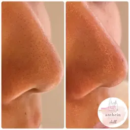 【皮脂ケア・黒ずみ対策・イチゴ鼻】毛穴のお掃除フェイシャル！