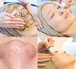 毛穴洗浄＋ハーブピーリング