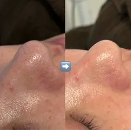 ハイドラフェイシャル(毛穴洗浄)